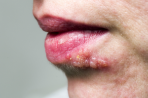 O que é herpes labial?
